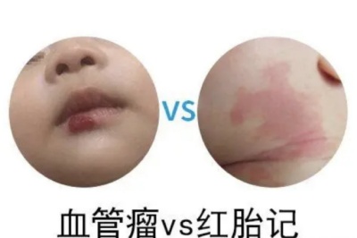 怎么判断是血管瘤还是胎记?